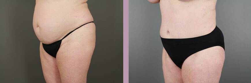 Case--15950 | Before and After Tummy Tuck 3