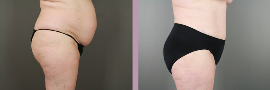 Case--15950 | Before and After Tummy Tuck 4
