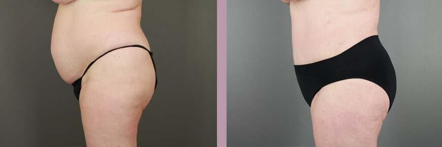 Case--15950 | Before and After Tummy Tuck 5