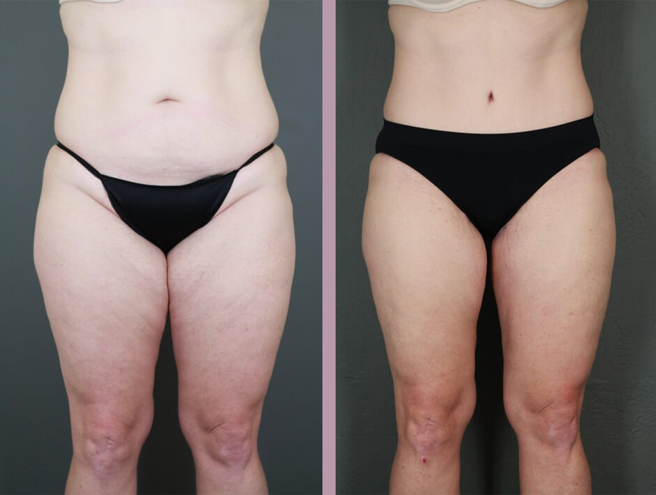 Case--15996 | Before and After Tummy Tuck