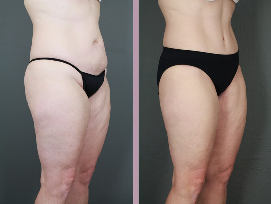 Case--15996 | Before and After Tummy Tuck 2