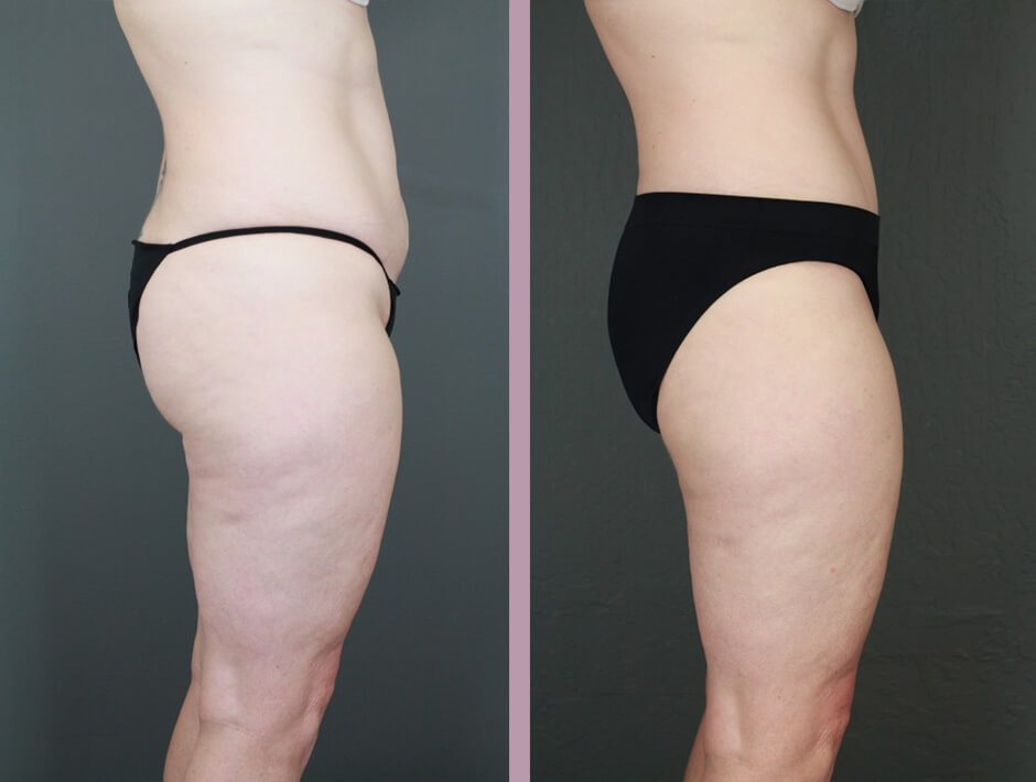 Case--15996 | Before and After Tummy Tuck 3