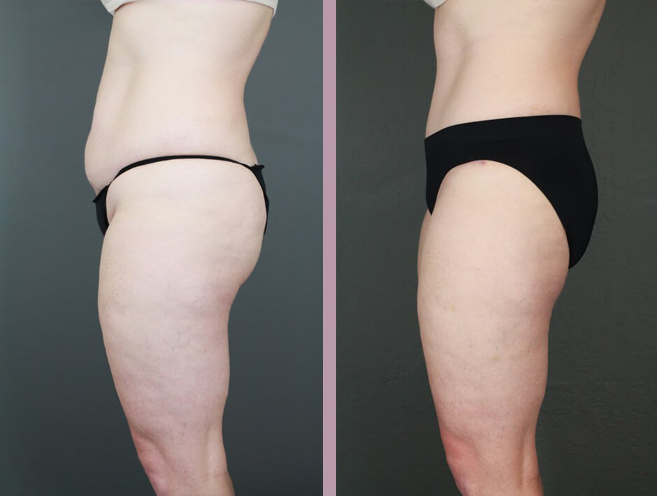 Case--15996 | Before and After Tummy Tuck 4