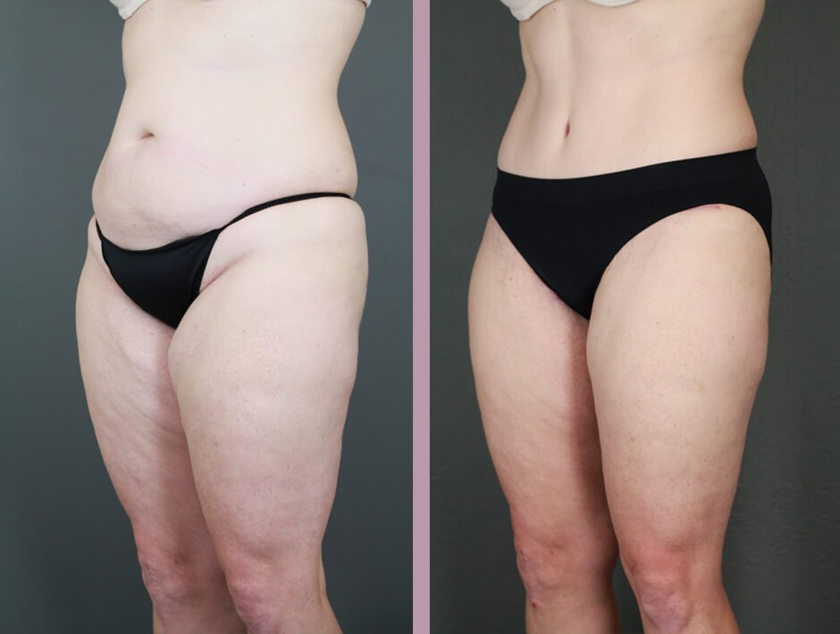 Case--15996 | Before and After Tummy Tuck 5