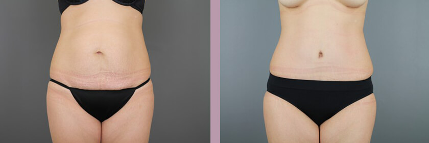 Case--16214 | Before and After Tummy Tuck