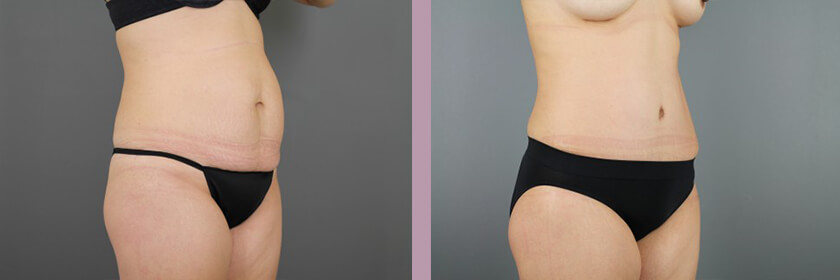 Case--16214 | Before and After Tummy Tuck 2
