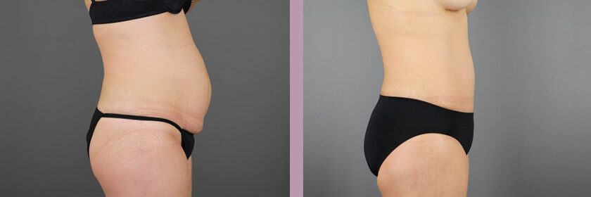 Case--16214 | Before and After Tummy Tuck 3