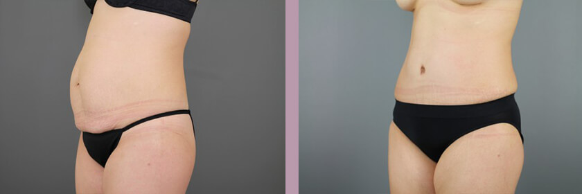 Case--16214 | Before and After Tummy Tuck 4