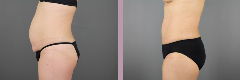 Case--16214 | Before and After Tummy Tuck 5