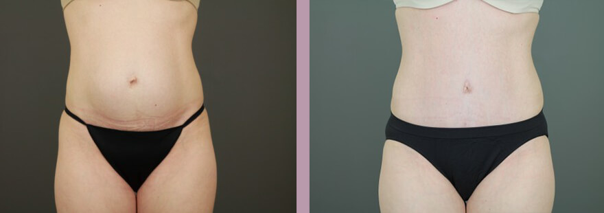 Case--16253 | Before and After Tummy Tuck