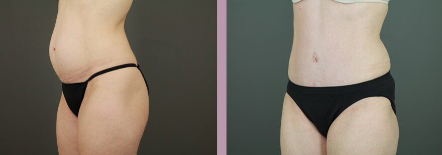 Case--16253 | Before and After Tummy Tuck 2