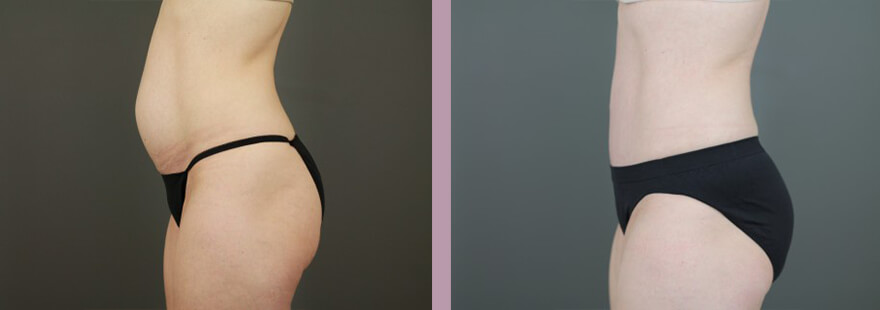 Case--16253 | Before and After Tummy Tuck 3