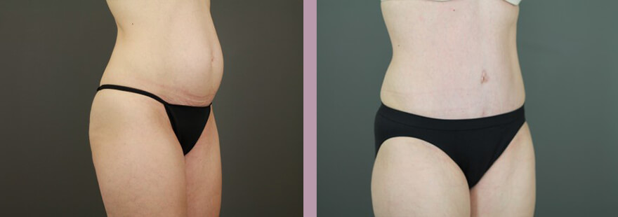 Case--16253 | Before and After Tummy Tuck 5