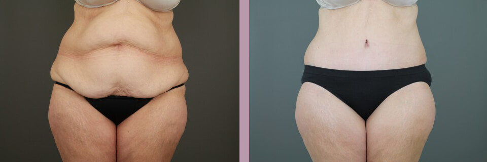 Case--16269 | Before and After Tummy Tuck