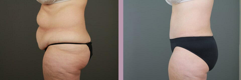 Case--16269 | Before and After Tummy Tuck 2