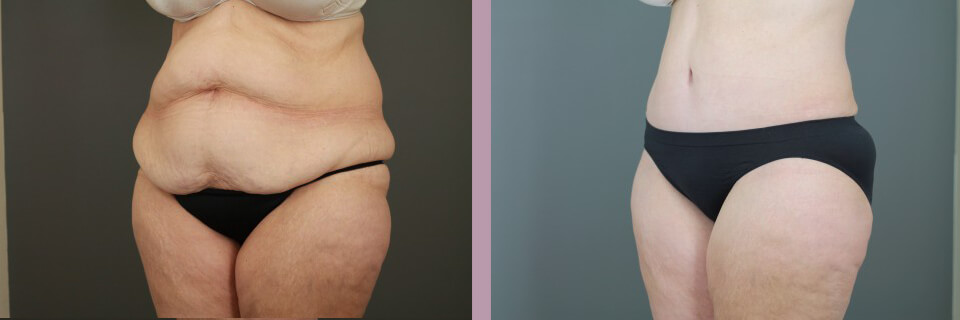 Case--16269 | Before and After Tummy Tuck 3