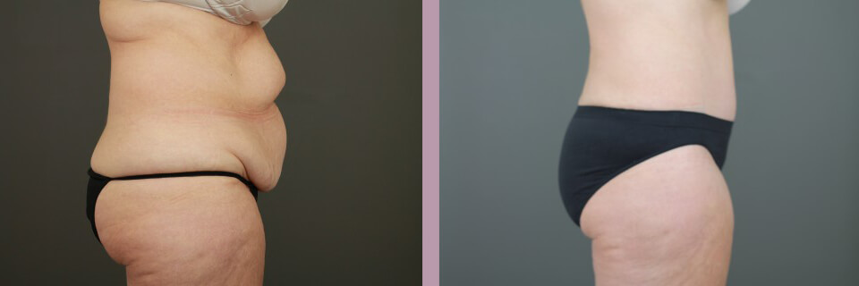 Case--16269 | Before and After Tummy Tuck 4