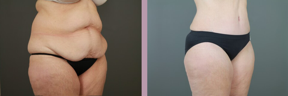 Case--16269 | Before and After Tummy Tuck 5