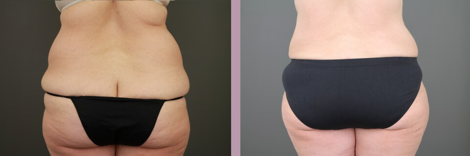 Case--16269 | Before and After Tummy Tuck 6