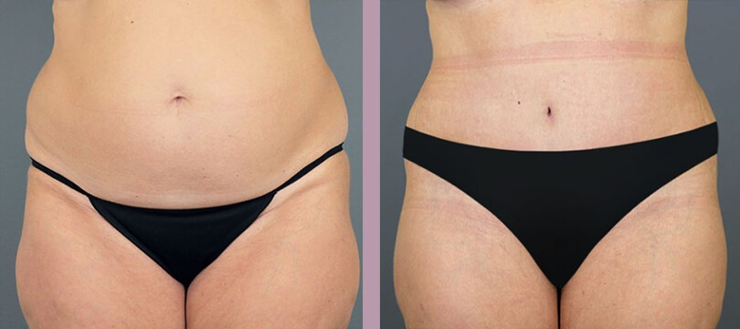 Case--16286 | Before and After Tummy Tuck