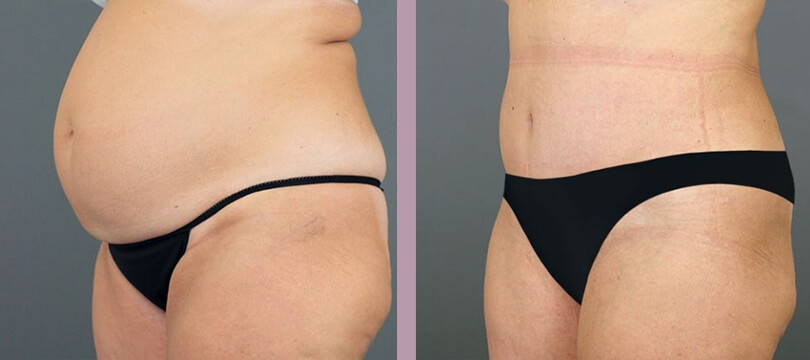 Case--16286 | Before and After Tummy Tuck 2