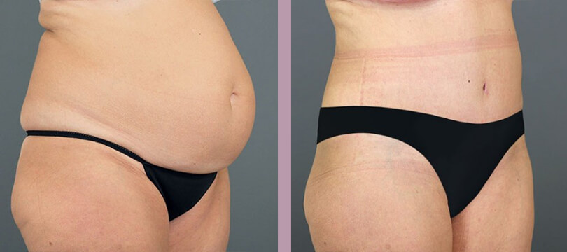 Case--16286 | Before and After Tummy Tuck 3