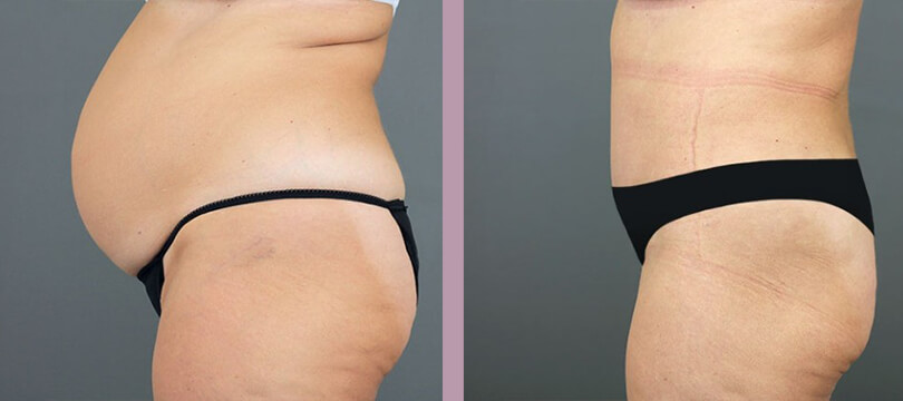 Case--16286 | Before and After Tummy Tuck 4