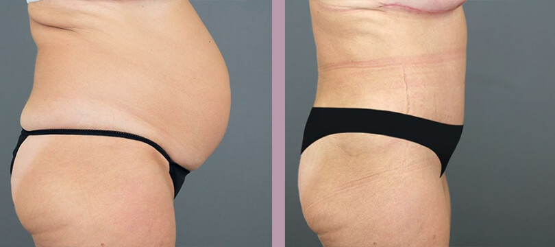 Case--16286 | Before and After Tummy Tuck 5