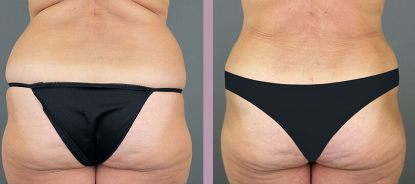 Case--16286 | Before and After Tummy Tuck 6