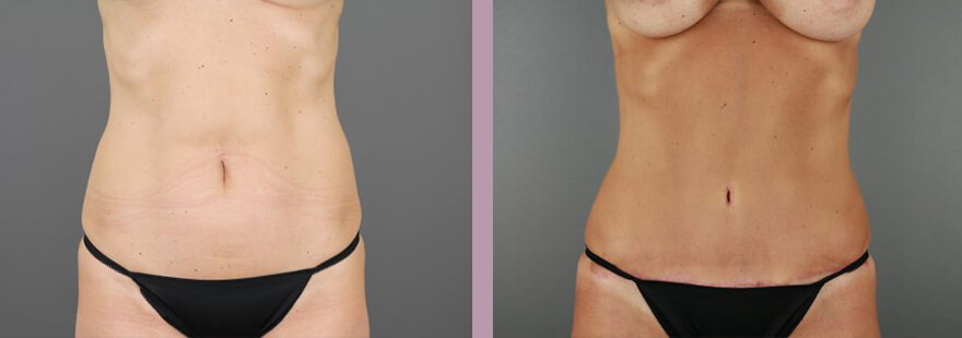 Case--16985 | Before and After Tummy Tuck