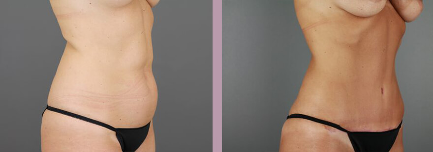 Case--16985 | Before and After Tummy Tuck 2