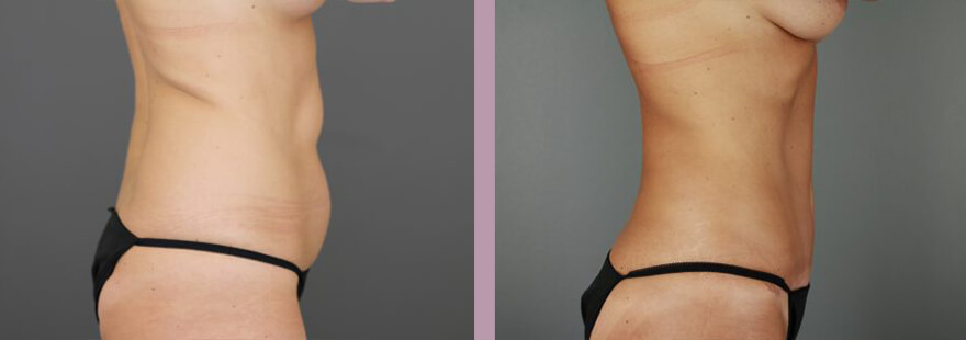 Case--16985 | Before and After Tummy Tuck 3