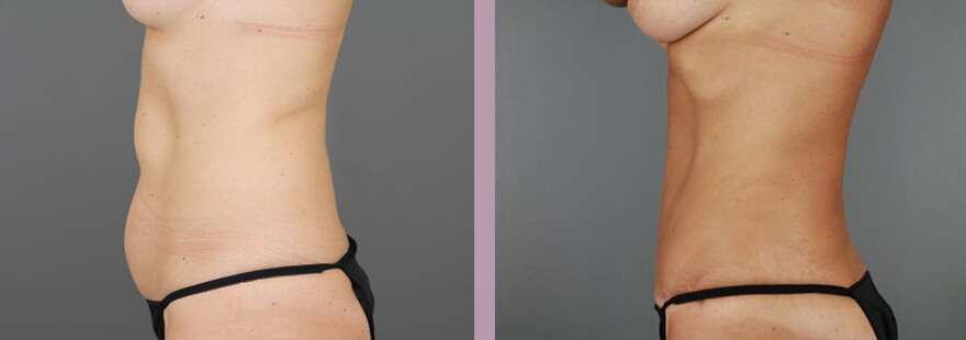 Case--16985 | Before and After Tummy Tuck 4