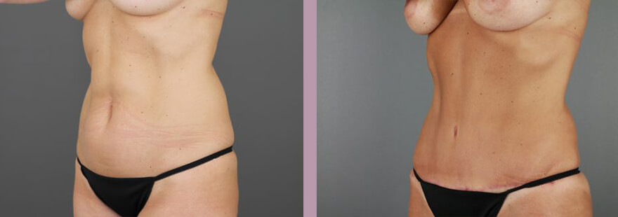 Case--16985 | Before and After Tummy Tuck 5