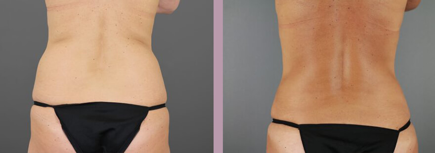 Case--16985 | Before and After Tummy Tuck 6