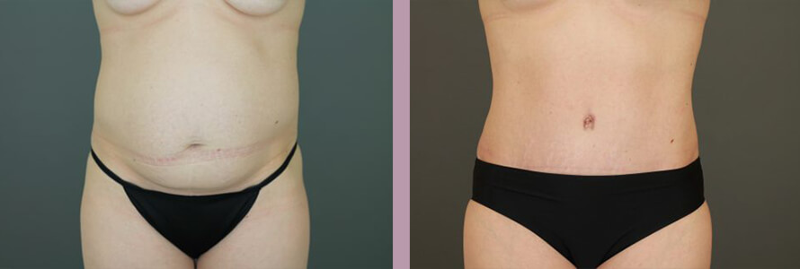 Case--16999 | Before and After Tummy Tuck