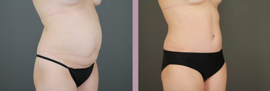 Case--16999 | Before and After Tummy Tuck 2