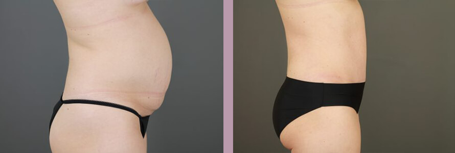 Case--16999 | Before and After Tummy Tuck 3