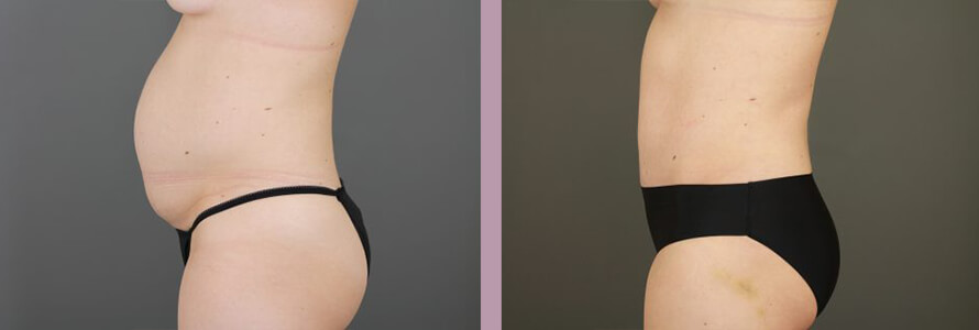 Case--16999 | Before and After Tummy Tuck 4