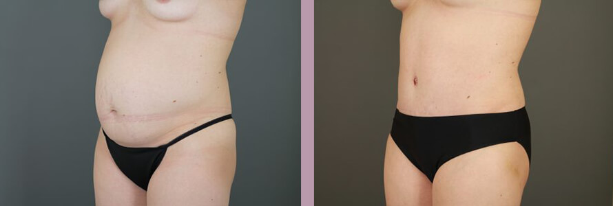 Case--16999 | Before and After Tummy Tuck 5