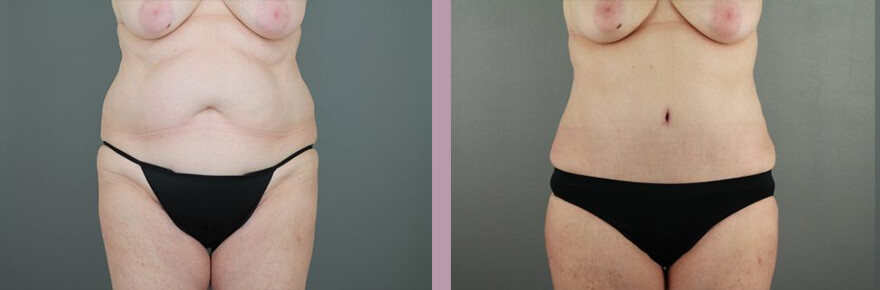 Case--17733 | Before and After Tummy Tuck