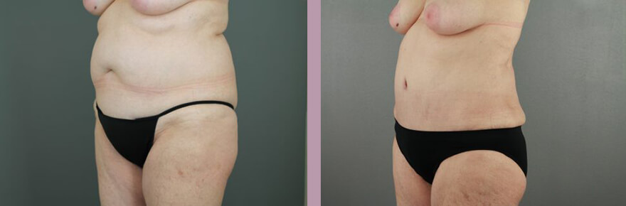 Case--17733 | Before and After Tummy Tuck 2