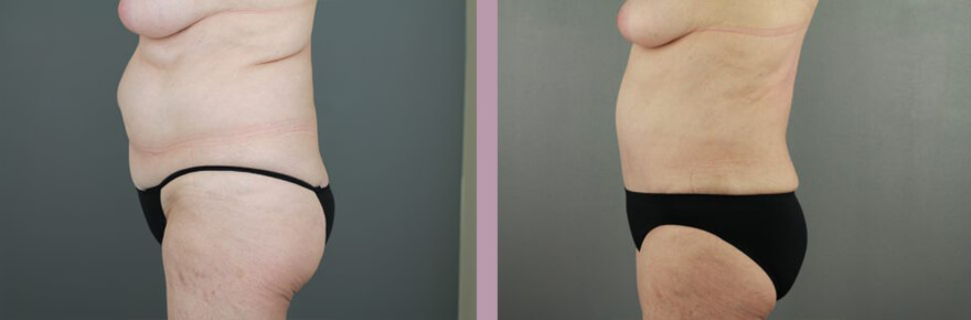 Case--17733 | Before and After Tummy Tuck 3