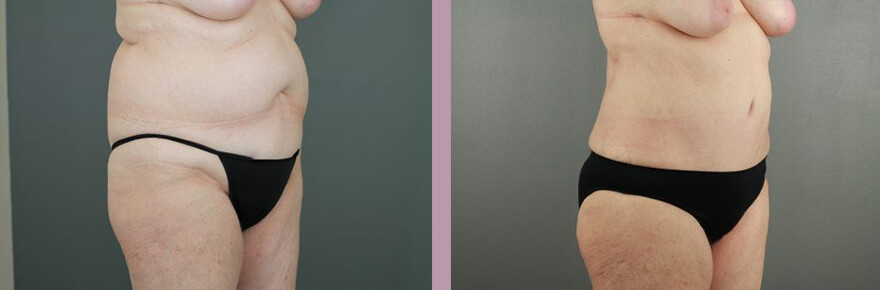 Case--17733 | Before and After Tummy Tuck 4