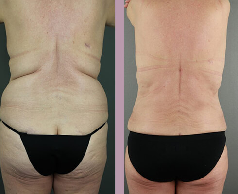 Case--17733 | Before and After Tummy Tuck 5