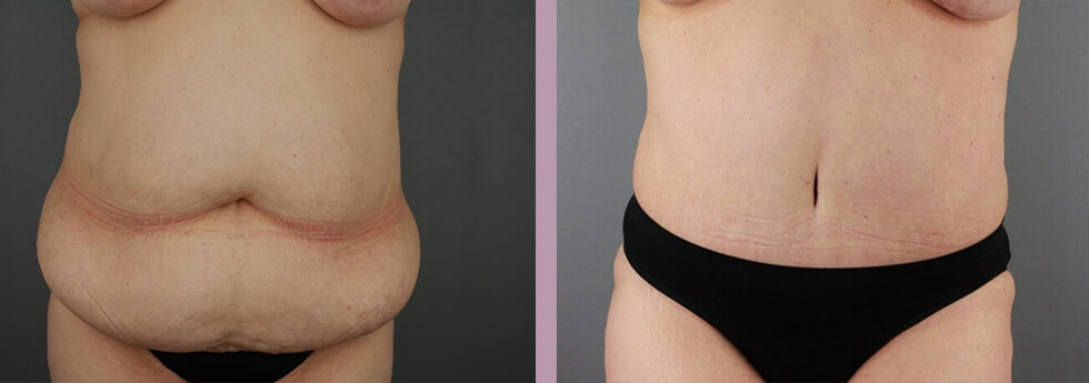 Case--21930 | Before and After Tummy Tuck