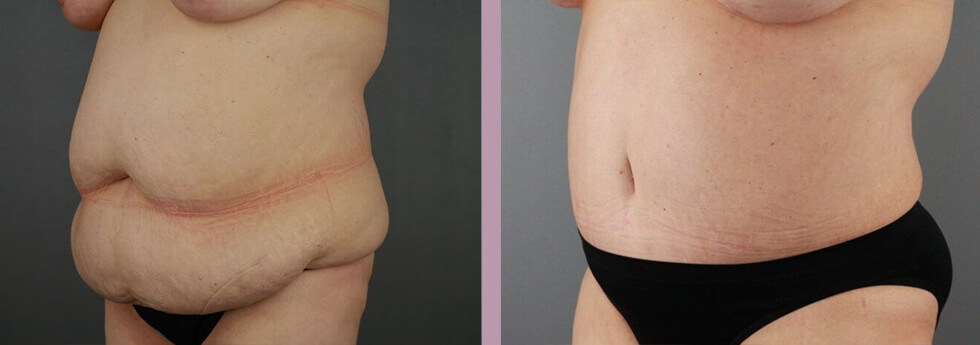 Case--21930 | Before and After Tummy Tuck 2
