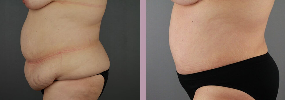 Case--21930 | Before and After Tummy Tuck 3