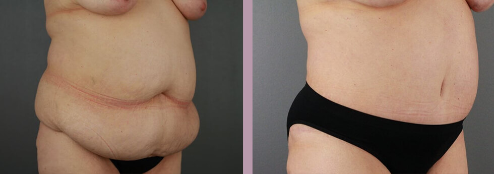 Case--21930 | Before and After Tummy Tuck 4