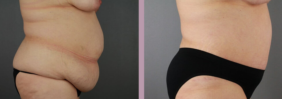 Case--21930 | Before and After Tummy Tuck 5